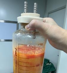 黄山水动力吸脂手术要做多久？